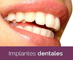 Implantes dentales