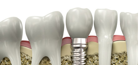 Qu son los implantes dentales y cundo se utilizan